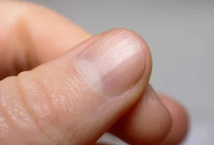 Alerta: dermatologista revela o que podem significar riscos nas unhas