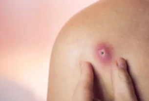 Furúnculo pode matar? Dermatologista alerta sobre riscos